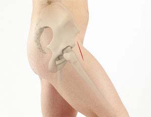 Anterior Approach Hip Replacement