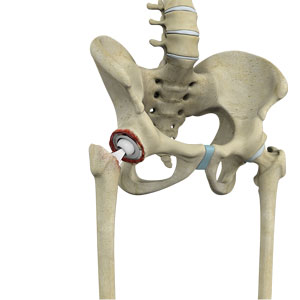 Revision Hip Replacement Surgery 