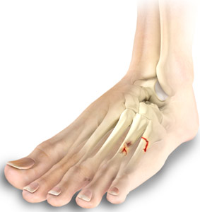 Toe And Fore Foot Fractures